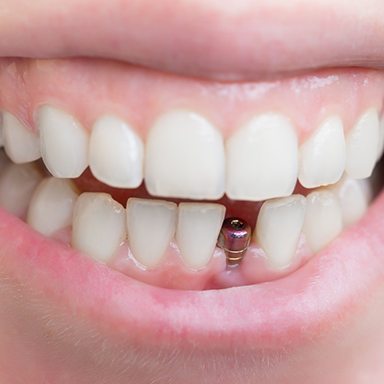 Close up of a dental implant in a mouth