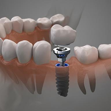 Dental implant receiving a crown and abutment