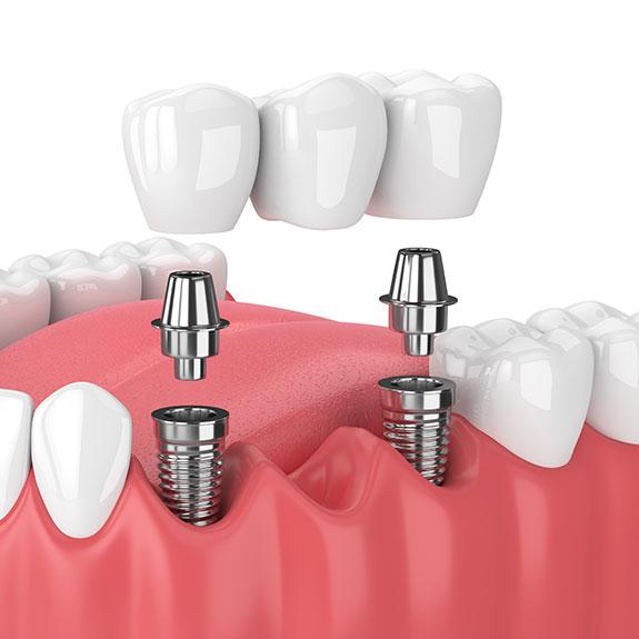 Animated dental implant bridge being placed