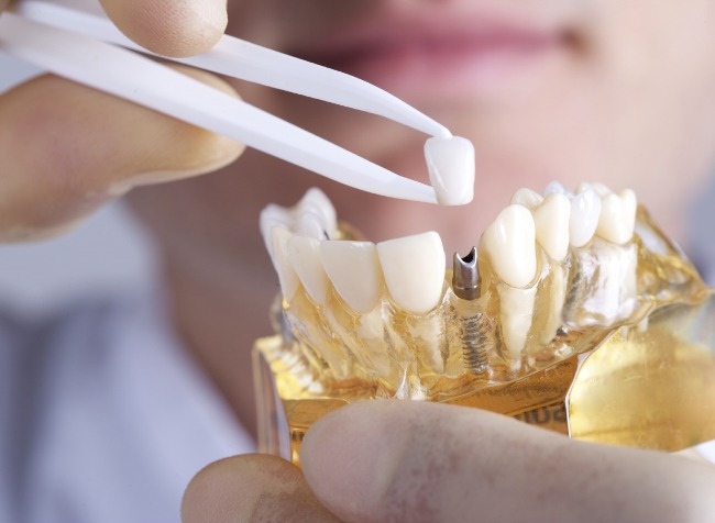 Dentist placing dental crown on model of dental implants