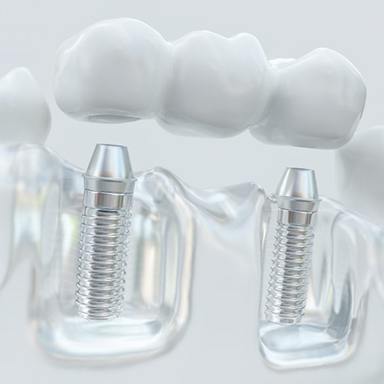 a 3 D example of a dental implant bridge