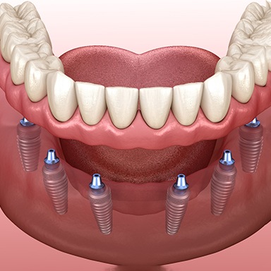 A diagram of a lower implant denture