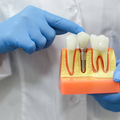 a dental implant model 