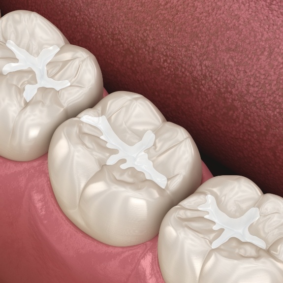 Animated row of teeth with dental sealants