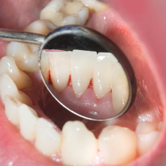 Close up of dental mirror in mouth showing red spots in gums