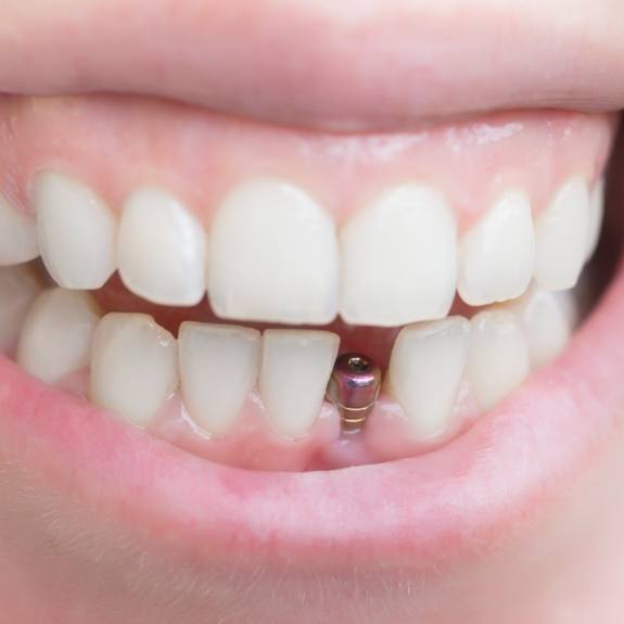 Close up of smile with visible dental implant abutment